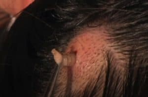 Larva Removed from a Girl's Scalp